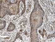 IHC staining of FFPE human esophageal squamous carcinoma tissue with Parkinson disease protein 7 antibody. HIER: boil tissue sections in pH8 EDTA for 20 min and allow to cool before testing.