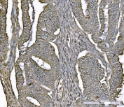 IHC staining of FFPE human endometrial carcinoma tissue with Parkinson disease protein 7 antibody. HIER: boil tissue sections in pH8 EDTA for 20 min and allow to cool before testing.