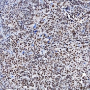 IHC staining of FFPE human ovarian serous cancer tissue with SF3a120 antibody. HIER: boil tissue sections in pH8 EDTA for 20 min and allow to cool before testing.