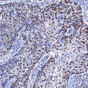 IHC staining of FFPE human larynx squamous cell carcinoma tissue with SF3a120 antibody. HIER: boil tissue sections in pH8 EDTA for 20 min and allow to cool before testing.