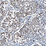IHC staining of FFPE human lung adenocarcinoma tissue with SF3a120 antibody. HIER: boil tissue sections in pH8 EDTA for 20 min and allow to cool before testing.