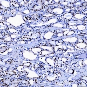 IHC staining of FFPE human prostate adenocarcinoma tissue with SF3a120 antibody. HIER: boil tissue sections in pH8 EDTA for 20 min and allow to cool before testing.