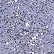IHC staining of FFPE human liver cancer tissue with SF3a120 antibody. HIER: boil tissue sections in pH8 EDTA for 20 min and allow to cool before testing.