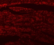 Immunofluorescent staining of FFPE human intestinal cancer tissue with SF3a120 antibody. HIER: steam section in pH8 EDTA buffer for 20 min.