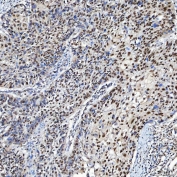 IHC staining of FFPE human larynx squamous cell carcinoma tissue with SF3a60 antibody. HIER: boil tissue sections in pH8 EDTA for 20 min and allow to cool before testing.