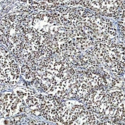 IHC staining of FFPE human lung adenocarcinoma tissue with SF3a60 antibody. HIER: boil tissue sections in pH8 EDTA for 20 min and allow to cool before testing.