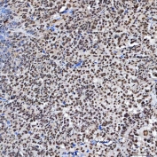 IHC staining of FFPE human ovarian serous cancer tissue with SF3a60 antibody. HIER: boil tissue sections in pH8 EDTA for 20 min and allow to cool before testing.