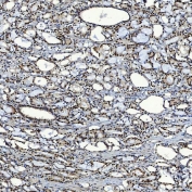 IHC staining of FFPE human prostate adenocarcinoma tissue with SF3a60 antibody. HIER: boil tissue sections in pH8 EDTA for 20 min and allow to cool before testing.