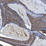IHC staining of FFPE human breast cancer tissue with SF3a60 antibody. HIER: boil tissue sections in pH8 EDTA for 20 min and allow to cool before testing.