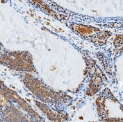 IHC staining of FFPE human breast cancer tissue with Sideroflexin-3 antibody. HIER: boil tissue sections in pH8 EDTA for 20 min and allow to cool before testing.