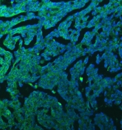 Immunofluorescent staining of FFPE human renal cancer tissue with Sideroflexin-3 antibody (green) and DAPI nuclear stain (blue). HIER: steam section in pH8 EDTA buffer for 20 min.