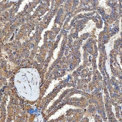 IHC staining of FFPE human thyroid cancer tissue with Sideroflexin-3 antibody. HIER: boil tissue sections in pH8 EDTA for 20 min and allow to cool before testing.