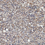 IHC staining of FFPE human liver cancer tissue with Sideroflexin-3 antibody. HIER: boil tissue sections in pH8 EDTA for 20 min and allow to cool before testing.