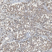 IHC staining of FFPE human lung adenocarcinoma tissue with Sideroflexin-3 antibody. HIER: boil tissue sections in pH8 EDTA for 20 min and allow to cool before testing.