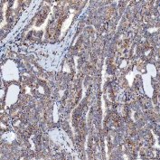 IHC staining of FFPE human thyroid cancer tissue with Sideroflexin-5 antibody. HIER: boil tissue sections in pH8 EDTA for 20 min and allow to cool before testing.