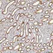 IHC staining of FFPE human renal cancer tissue with Sideroflexin-5 antibody. HIER: boil tissue sections in pH8 EDTA for 20 min and allow to cool before testing.