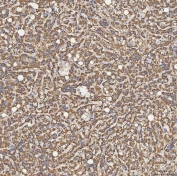 IHC staining of FFPE human liver cancer tissue with Sideroflexin-5 antibody. HIER: boil tissue sections in pH8 EDTA for 20 min and allow to cool before testing.