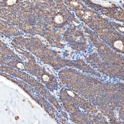 IHC staining of FFPE human breast cancer tissue with Sideroflexin-5 antibody. HIER: boil tissue sections in pH8 EDTA for 20 min and allow to cool before testing.