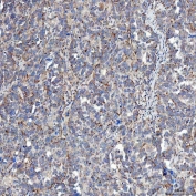 IHC staining of FFPE human ovarian serous cancer tissue with Sideroflexin-5 antibody. HIER: boil tissue sections in pH8 EDTA for 20 min and allow to cool before testing.