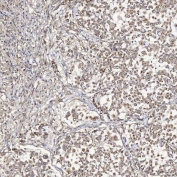 IHC staining of FFPE human lung adenocarcinoma tissue with Sideroflexin-5 antibody. HIER: boil tissue sections in pH8 EDTA for 20 min and allow to cool before testing.
