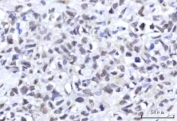 IHC staining of FFPE human gastric adenocarcinoma tissue with RNA-binding protein 22 antibody. HIER: boil tissue sections in pH8 EDTA for 20 min and allow to cool before testing.