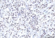 IHC staining of FFPE human breast cancer tissue with RNA-binding protein 22 antibody. HIER: boil tissue sections in pH8 EDTA for 20 min and allow to cool before testing.