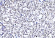 IHC staining of FFPE human lung squamous cell carcinoma tissue with RNA-binding protein 22 antibody. HIER: boil tissue sections in pH8 EDTA for 20 min and allow to cool before testing.