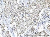 IHC staining of FFPE human esophageal squamous carcinoma with RNA-binding protein 22 antibody. HIER: boil tissue sections in pH8 EDTA for 20 min and allow to cool before testing.