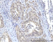 IHC staining of FFPE human appendix adenocarcinoma with RNA-binding protein 22 antibody. HIER: boil tissue sections in pH8 EDTA for 20 min and allow to cool before testing.