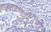 IHC staining of FFPE human rectum adenocarcinoma with RNA-binding protein 22 antibody. HIER: boil tissue sections in pH8 EDTA for 20 min and allow to cool before testing.