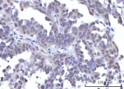 IHC staining of FFPE human ovarian serous carcinoma tissue with RNA-binding protein 22 antibody. HIER: boil tissue sections in pH8 EDTA for 20 min and allow to cool before testing.