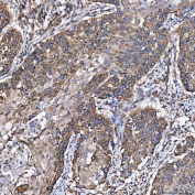 IHC staining of FFPE human larynx squamous cell carcinoma tissue with SH2D4A antibody. HIER: boil tissue sections in pH8 EDTA for 20 min and allow to cool before testing.