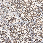 IHC staining of FFPE human lung adenocarcinoma tissue with SH2D4A antibody. HIER: boil tissue sections in pH8 EDTA for 20 min and allow to cool before testing.