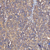 IHC staining of FFPE human ovarian serous cancer tissue with SH2D4A antibody. HIER: boil tissue sections in pH8 EDTA for 20 min and allow to cool before testing.
