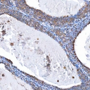 IHC staining of FFPE human breast cancer tissue with SH2D4A antibody. HIER: boil tissue sections in pH8 EDTA for 20 min and allow to cool before testing.