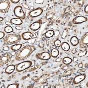 IHC staining of FFPE human renal cancer tissue with SH2D4A antibody. HIER: boil tissue sections in pH8 EDTA for 20 min and allow to cool before testing.