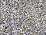 IHC staining of FFPE human lung squamous cell carcinoma tissue with ANXA1 antibody. HIER: boil tissue sections in pH8 EDTA for 20 min and allow to cool before testing.