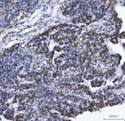 IHC staining of FFPE human bladder epithelial carcinoma tissue with Lamin A/C antibody. HIER: boil tissue sections in pH8 EDTA for 20 min and allow to cool before testing.