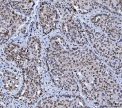 IHC staining of FFPE human liver cancer tissue with Lamin A/C antibody. HIER: boil tissue sections in pH8 EDTA for 20 min and allow to cool before testing.
