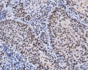 IHC staining of FFPE human laryngeal squamous cell carcinoma tissue with Lamin A/C antibody. HIER: boil tissue sections in pH8 EDTA for 20 min and allow to cool before testing.