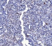 IHC staining of FFPE human ovarian cancer tissue with Lamin A/C antibody. HIER: boil tissue sections in pH8 EDTA for 20 min and allow to cool before testing.