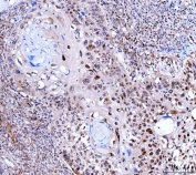 IHC staining of FFPE human laryngeal squamous cell carcinoma tissue with FAM60A antibody. HIER: boil tissue sections in pH8 EDTA for 20 min and allow to cool before testing.