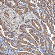 IHC staining of FFPE human rectum adenocarcinoma tissue with FAM60A antibody. HIER: boil tissue sections in pH8 EDTA for 20 min and allow to cool before testing.