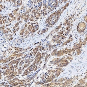 IHC staining of FFPE human prostate adenocarcinoma tissue with FAM60A antibody. HIER: boil tissue sections in pH8 EDTA for 20 min and allow to cool before testing.