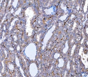 IHC staining of FFPE human thyroid cancer tissue with NHERF-2 antibody. HIER: boil tissue sections in pH8 EDTA for 20 min and allow to cool before testing.