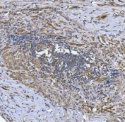 IHC staining of FFPE human colorectal adenocarcinoma tissue with NHERF-2 antibody. HIER: boil tissue sections in pH8 EDTA for 20 min and allow to cool before testing.