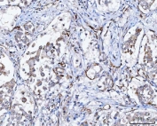 IHC staining of FFPE human lung cancer tissue with NHERF-2 antibody. HIER: boil tissue sections in pH8 EDTA for 20 min and allow to cool before testing.