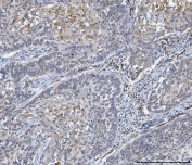 IHC staining of FFPE human laryngeal squamous cell carcinoma tissue with NHERF-2 antibody. HIER: boil tissue sections in pH8 EDTA for 20 min and allow to cool before testing.