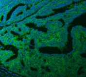 Immunofluorescent staining of FFPE human ovarian cancer tissue with Ferroportin 1 antibody (green) and DAPI nuclear stain (blue). HIER: steam section in pH8 EDTA buffer for 20 min.