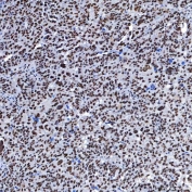 IHC staining of FFPE human ovarian serous cancer tissue with SAP130 antibody. HIER: boil tissue sections in pH8 EDTA for 20 min and allow to cool before testing.